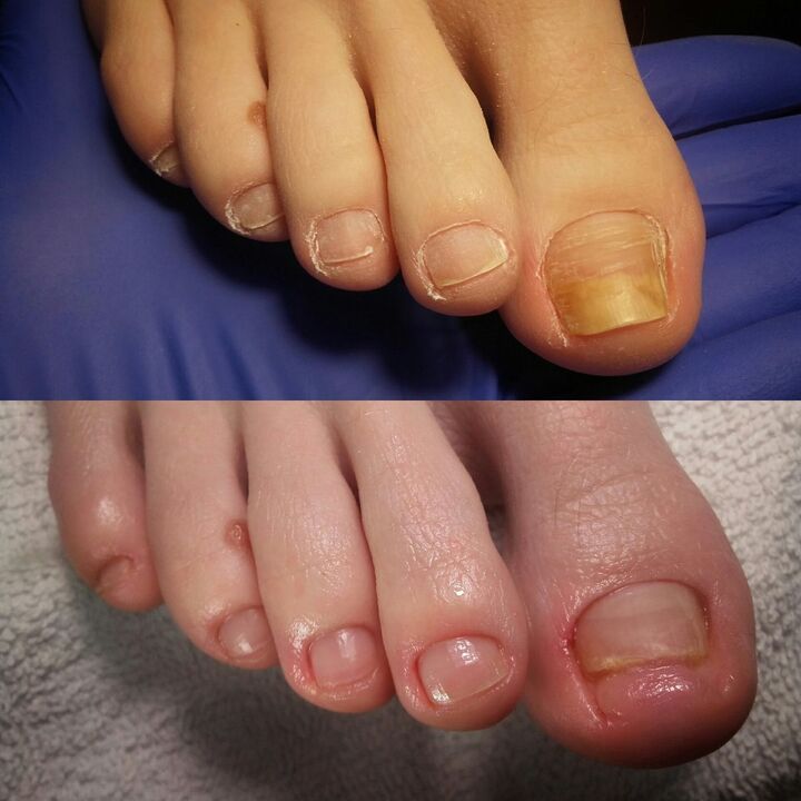 Antes y después de aplicar la marca de exodermina de la marca Creme desde Yesenia